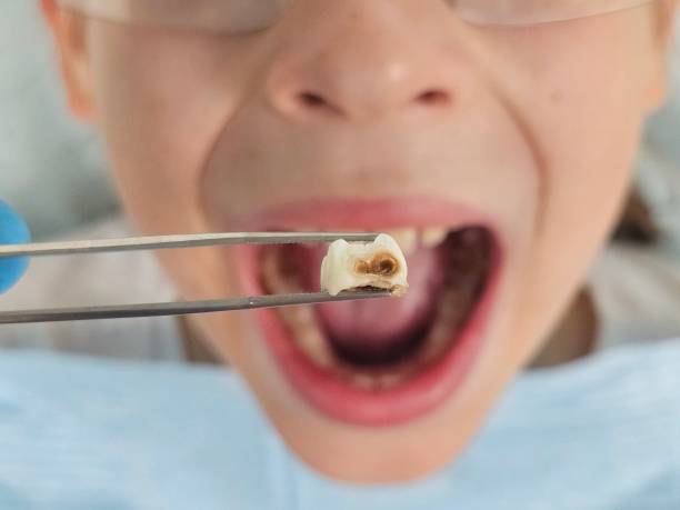 Best Emergency Root Canal Treatment in Nellysford, VA
